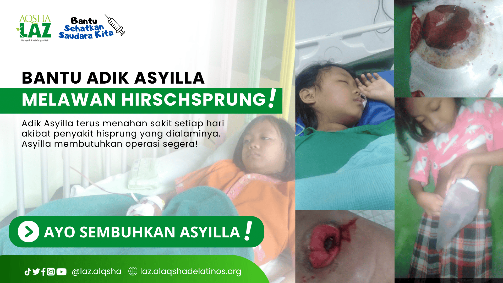 AYO BANTU ADIK ASYILLA MELAWAN HIRSCHSPRUNG